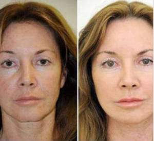 Beauty Age Skin - ingredientes - como tomar - funciona
